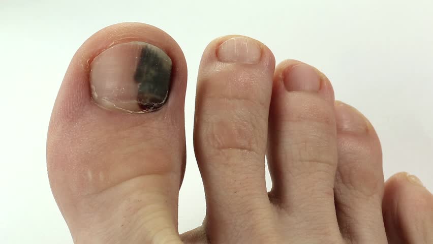 risks-of-diabetic-black-toenail-discoloration-black-toenail-fungus