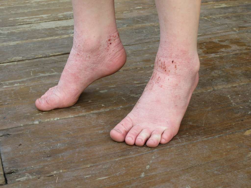 Reasons To Know Why Your Feet Are Peeling