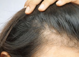 Benefits Of Pep Factor On Hair Loss And Scalp Rejuvenation scalp rejuvenation